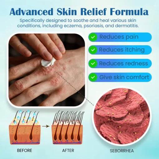 Seurico™ Eczema, Psoriasis Cream