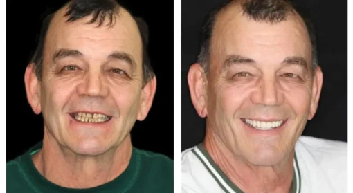 Seurico™ - Advanced Customized Full Denture Set