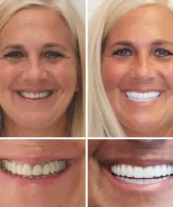 Seurico™ - Advanced Customized Full Denture Set