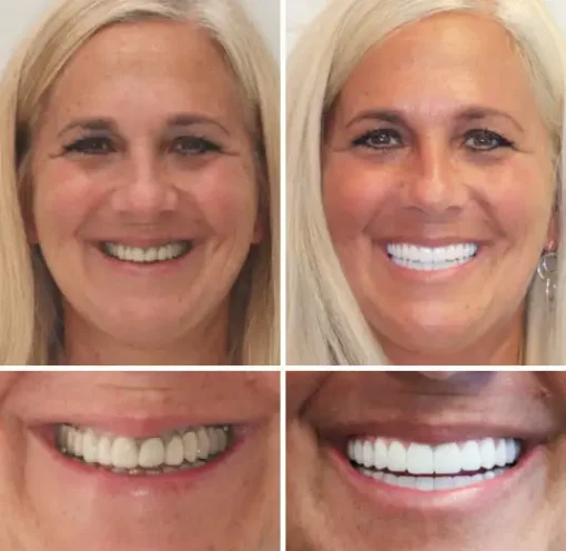 Seurico™ - Advanced Customized Full Denture Set
