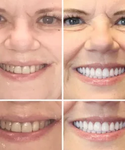 Seurico™ - Advanced Customized Full Denture Set