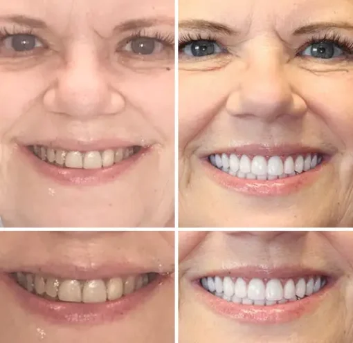 Seurico™ - Advanced Customized Full Denture Set