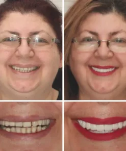 Seurico™ - Advanced Customized Full Denture Set