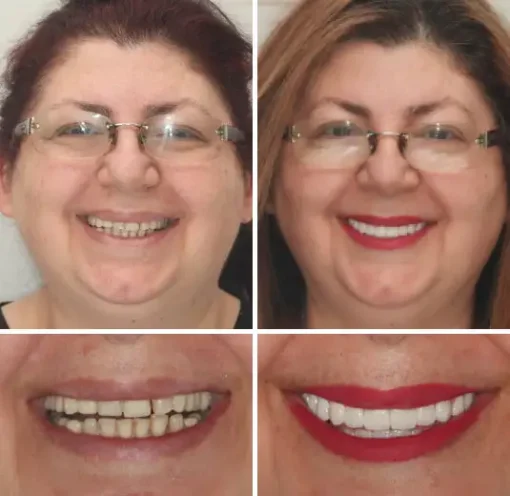 Seurico™ - Advanced Customized Full Denture Set