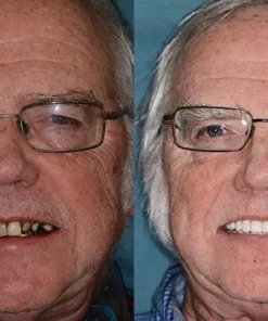 Seurico™ - Advanced Customized Full Denture Set