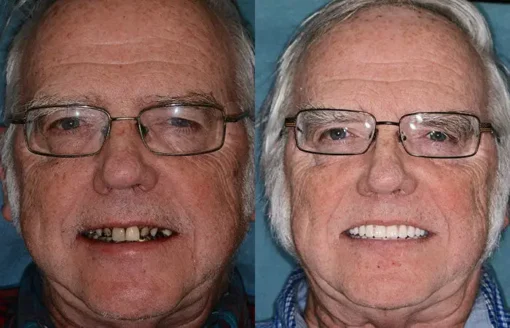 Seurico™ - Advanced Customized Full Denture Set