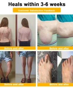Seurico™ Botulinum Toxin & Bee Venom Pain-Relief Bone Healing Cream