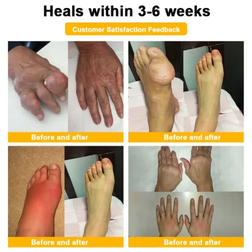Seurico™ Botulinum Toxin & Bee Venom Pain-Relief Bone Healing Cream
