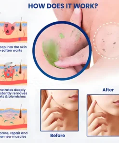 Seurico™ Instant Blemish & Mole Eraser Gel