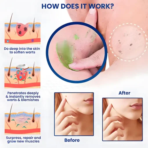 Seurico™ Instant Blemish & Mole Eraser Gel