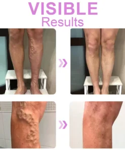 Seurico™ Varicose Veins Cream