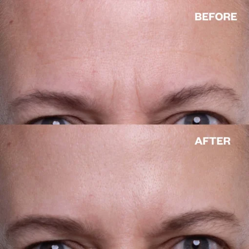 Seurico™ Forehead Wrinkle Patches