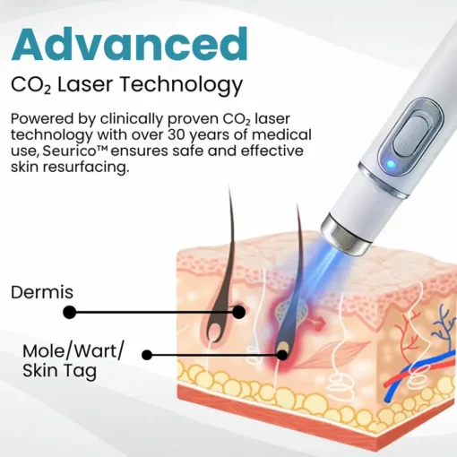 Seurico™ Laser Pen - Non-invasive Mole and Wart Removal