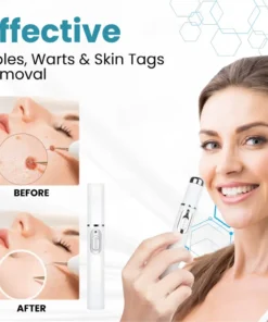 Seurico™ Laser Pen - Non-invasive Mole and Wart Removal