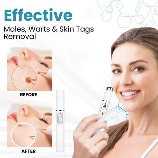 Seurico™ Laser Pen - Non-invasive Mole and Wart Removal