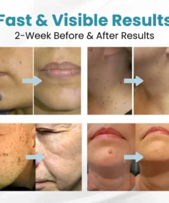 Seurico™ Laser Pen - Non-invasive Mole and Wart Removal