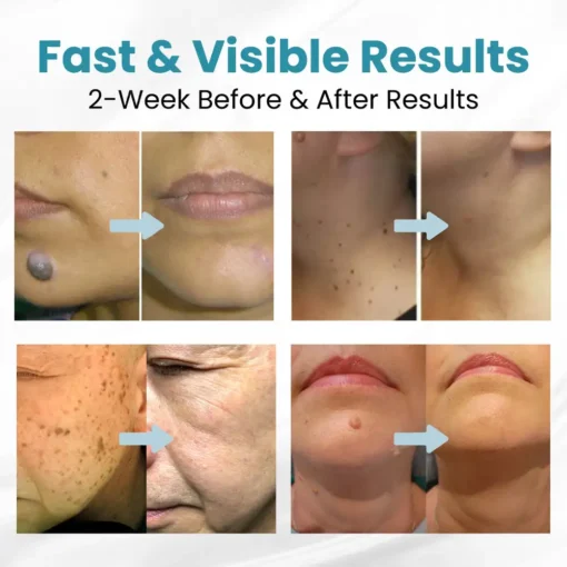 Seurico™ Laser Pen - Non-invasive Mole and Wart Removal