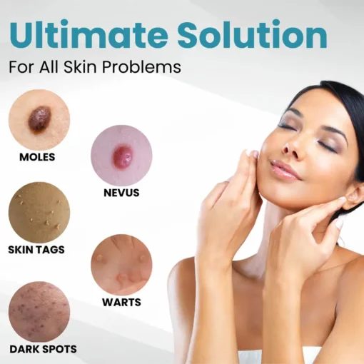 Seurico™ Laser Pen - Non-invasive Mole and Wart Removal
