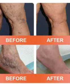 Seurico™ VeinEase Mikronadel-Therapie- Aufnaher