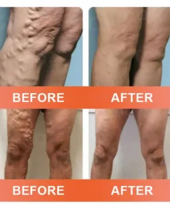 Seurico™ VeinEase Mikronadel-Therapie- Aufnaher