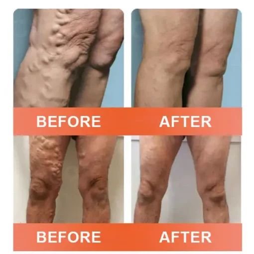 Seurico™ VeinEase Mikronadel-Therapie- Aufnaher