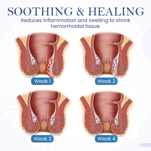 Seurico™ Herbal Hemorrhoid Treatment