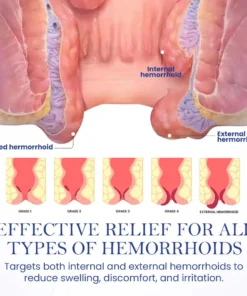 Seurico™ Herbal Hemorrhoid Treatment