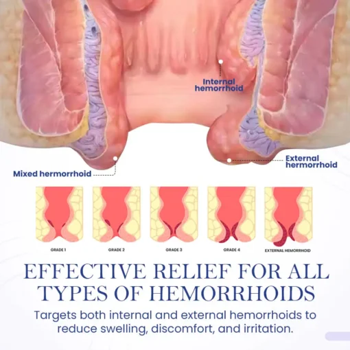 Seurico™ Herbal Hemorrhoid Treatment