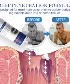 Seurico™ Herbal Hemorrhoid Treatment