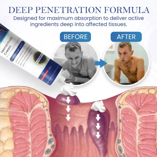 Seurico™ Herbal Hemorrhoid Treatment