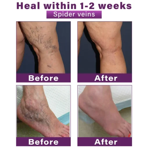 Seurico™ Polidocanol Nano Varicose Vein Patch