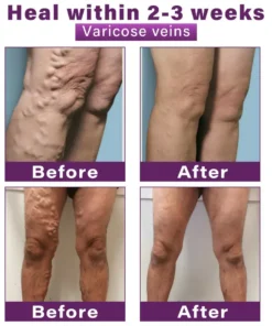 Seurico™ Polidocanol Nano Varicose Vein Patch