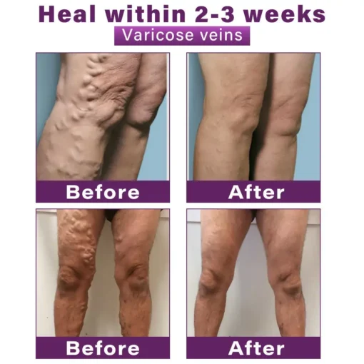 Seurico™ Polidocanol Nano Varicose Vein Patch