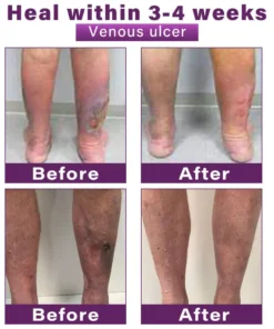 Seurico™ Polidocanol Nano Varicose Vein Patch