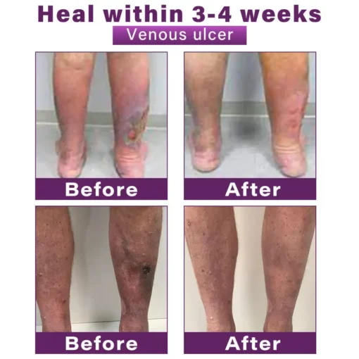 Seurico™ Polidocanol Nano Varicose Vein Patch
