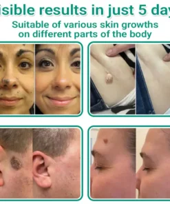 Seurico™ Magnesium MicroPin Target & Clear Wart Removal Patch