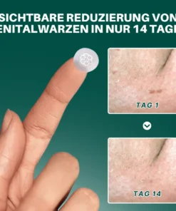 Seurico™ Magnesium Mikropin HPV Genitalien Warzen Entfernung Patch Pro