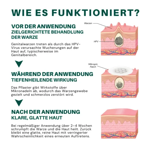 Seurico™ Magnesium Mikropin HPV Genitalien Warzen Entfernung Patch Pro