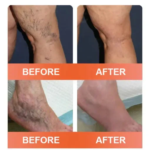 Seurico™ Vein Ease Microneedle Care Patch