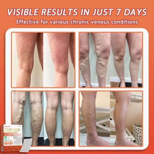 Seurico™ Vein Ease Microneedle Care Patch