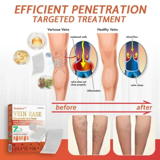 Seurico™ Vein Ease Microneedle Care Patch