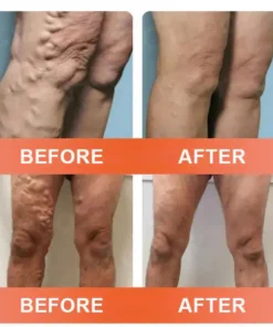 Seurico™ Vein Ease Microneedle Care Patch