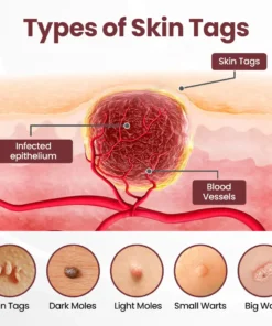 Seurico™KeraErase Dual-Action Renewal Cream