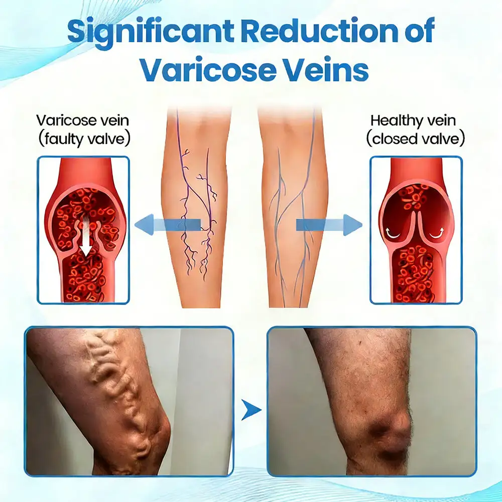 Seurico™ Advanced Vein Healing Spray